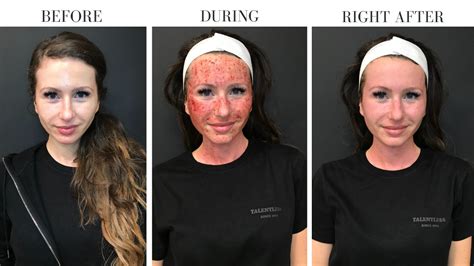 Vivace Treatment Results. After one treatment, changes are visible and noticeable, and after three treatments, patients can expect desired results. For best results, patients are advised not to wear makeup after the procedure. Patients should wait at least a day before applying any sort of cosmetic product.